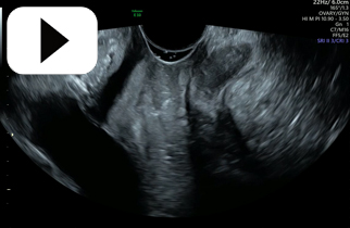 Normal Urethra Bladder anterior and posterior vaginal walls