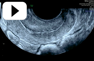 Bowel Sliding off posterior cervix-sliding sign