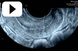 Bowel Sliding off posterior cervix-sliding sign