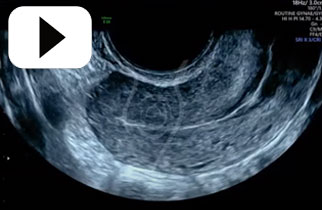 Bowel sliding off Uterine  fundus and posterior uterine wall -sliding sign