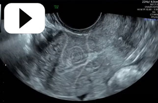 Perimenopausal- Late proliferative endometrium small ovary with 3 follicles