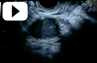 Benign Ovarian Tumour Bilateral Dermoid Cysts Left ovary 2D