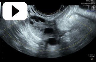 Ovaries PCO bilateral part 2 3D acquisition 2D
