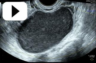 Common Benign Ovarian Cyst Endometrioma