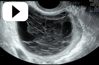 Common Benign Ovarian Cyst Haemorrhagic Cyst 2D