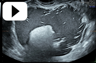 Benign Ovarian Tumour Bilateral Dermoid Cysts Left ovary 3D Static