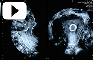 Uterine Cavity 3D Multiplanar Intra uterine Ball IUD