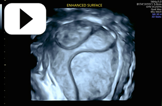 Uterine Cavity Enhanced Surface Rendering