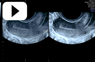 VCI A- plane proliferative Endometrium