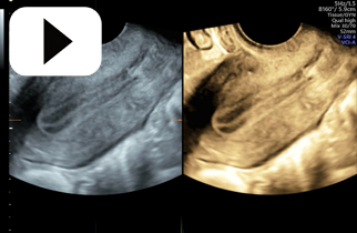 VCI-a-plane endometrium myometrial contractions